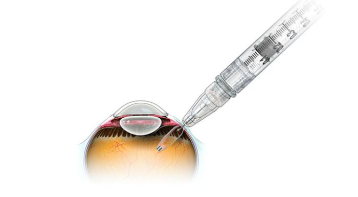 FDA, Genentech’in ilaç salınımlı göz implantı için biyolojik lisans başvurusunu kabul etti