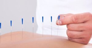 Akupunktur nedir?